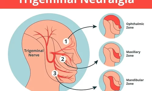 Naturopathic Perspectives on Trigeminal Neuralgia