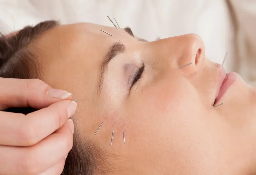 cosmetic-acupuncture-2 (1)