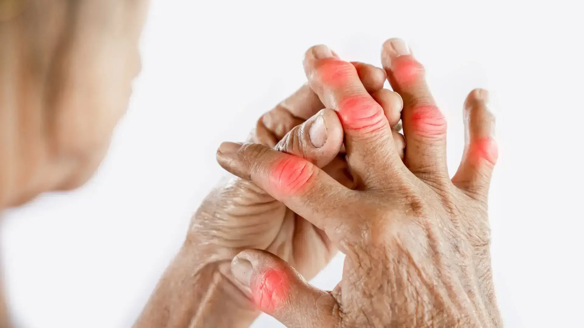 Arthritis / Arthralgia (joint pain), Pain Management