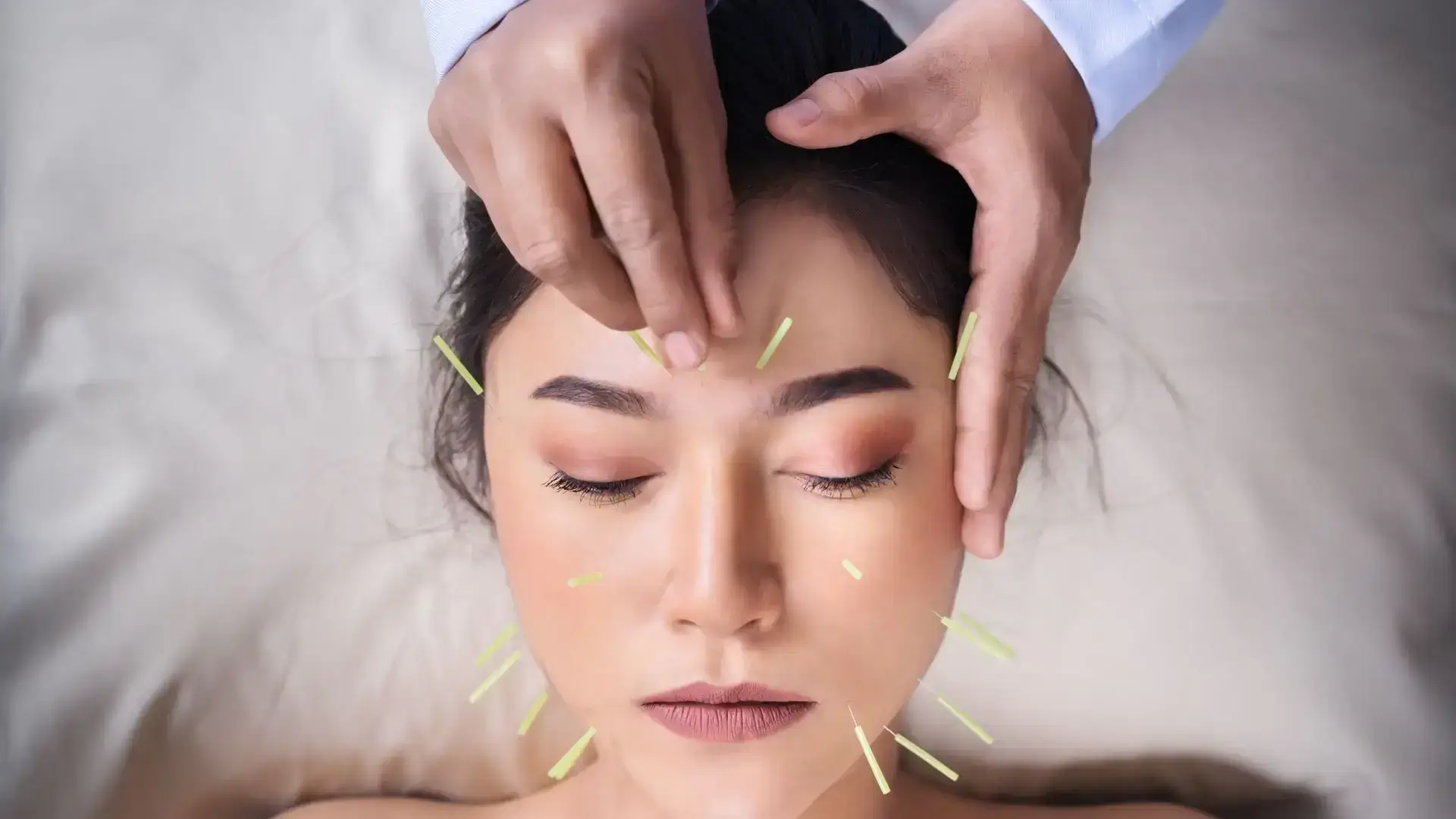 Cosmetic Acupuncture