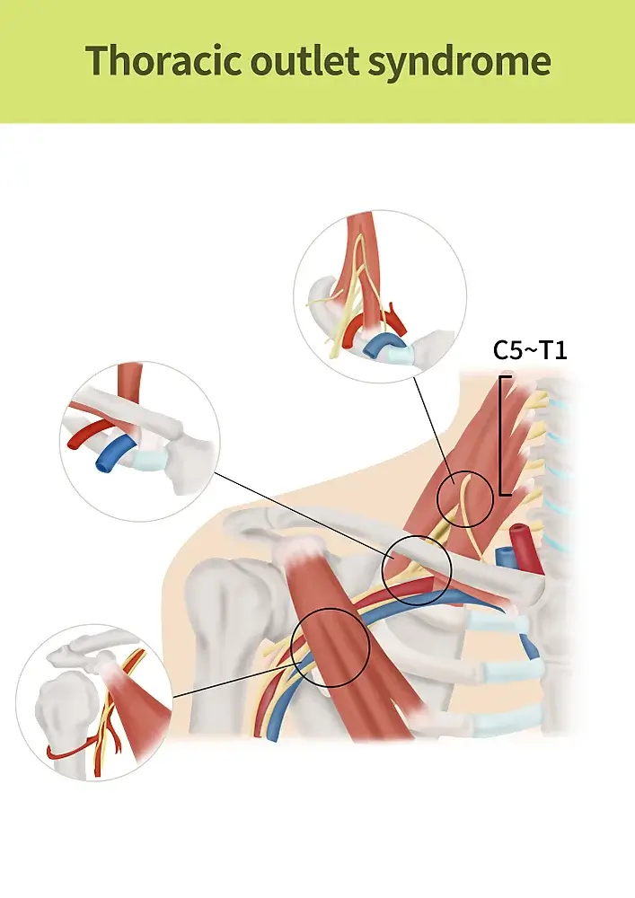 Naturopathic Considerations for Thoracic Outlet Syndrome