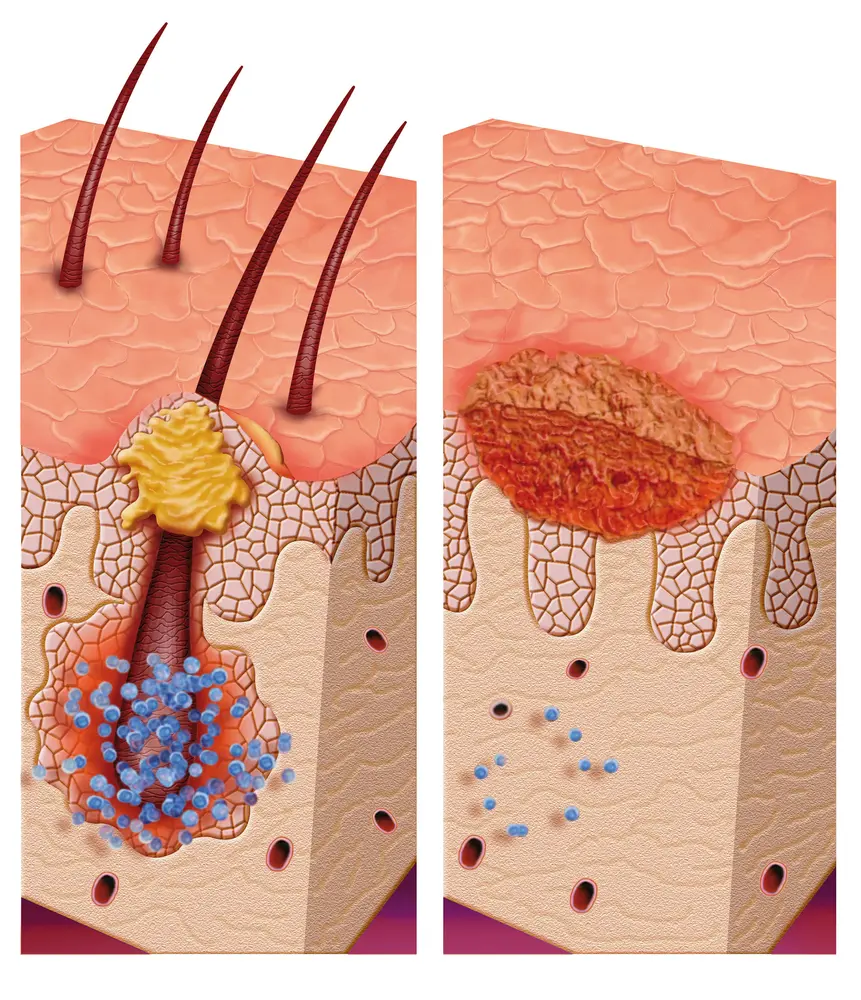 Pityrosporum folliculitis