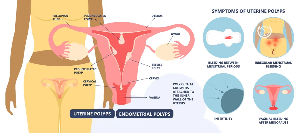 Severe Bleeding After Menopause