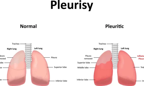 Pleurisy