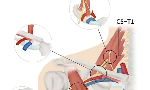 Naturopathic Considerations for Thoracic Outlet Syndrome