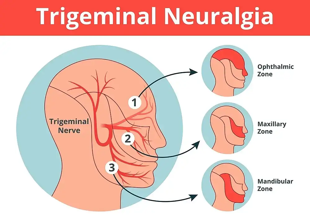 Naturopathic Perspectives on Trigeminal Neuralgia