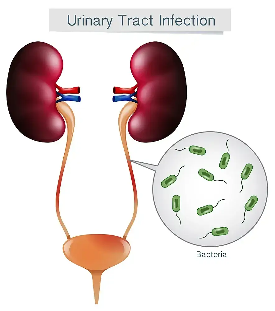 Naturopathic Approaches to Urinary Tract Infections (UTI) – Addressing Urinary Frequency, Urgency, and Burning Sensation during Urination