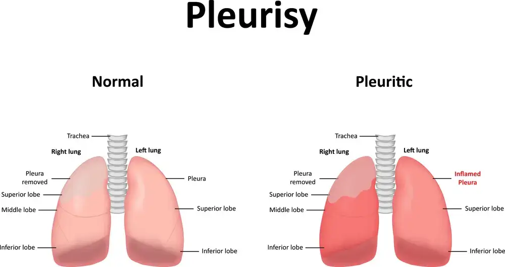 Pleurisy