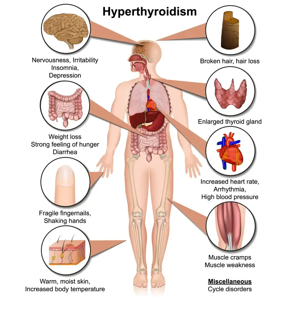 Indications of an Overactive Thyroid as Perceived by a Naturopath