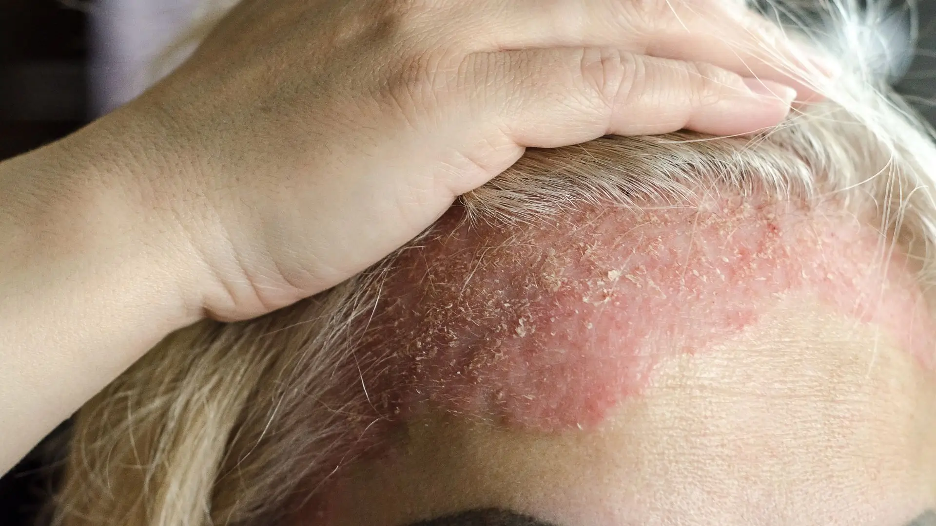 Naturopathic Remedies for Psoriasis and Skin Disorders