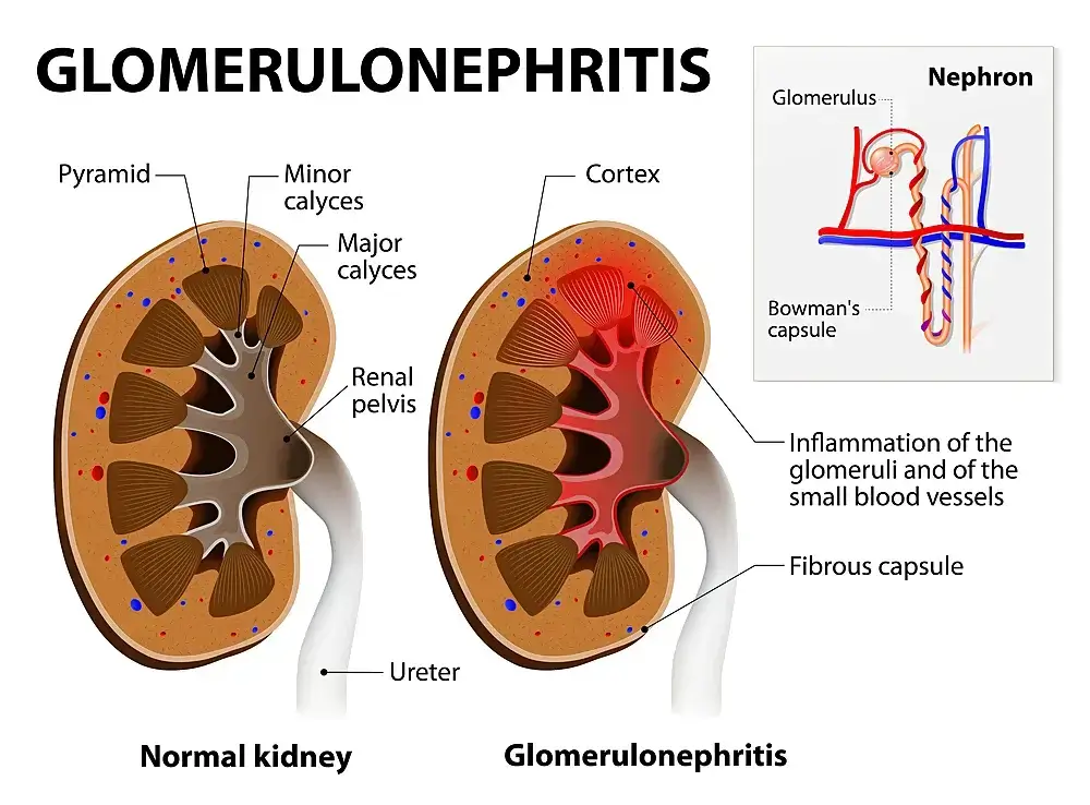 Glomerulonephritis, Kidneys