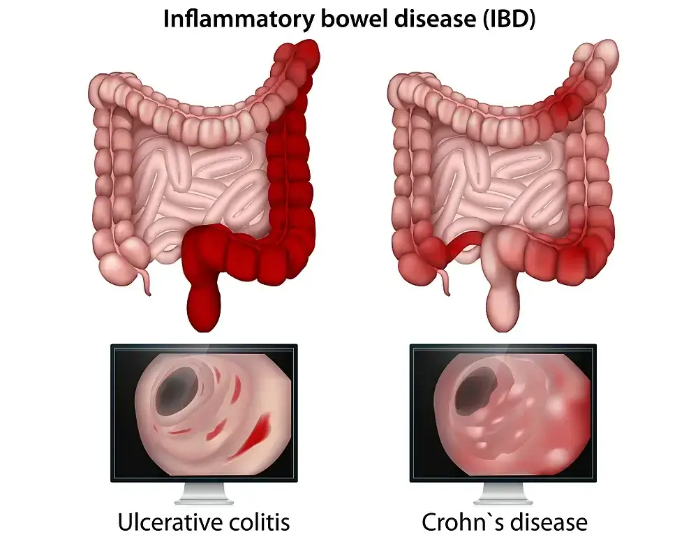 Inflammatory Bowel Disease (IBD), Gastrointestinal Disorders