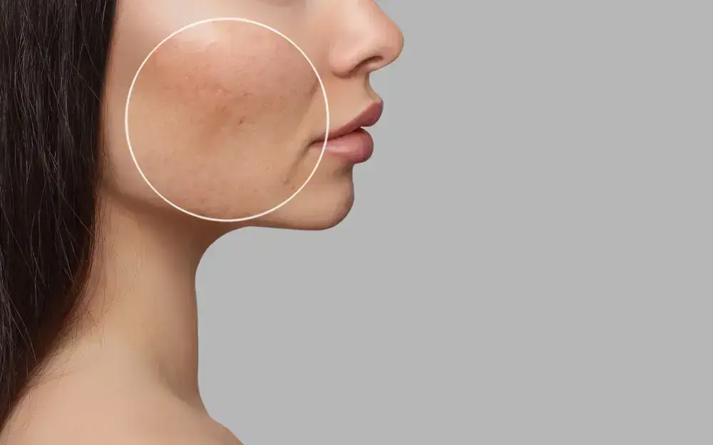 Naturopath for Acne