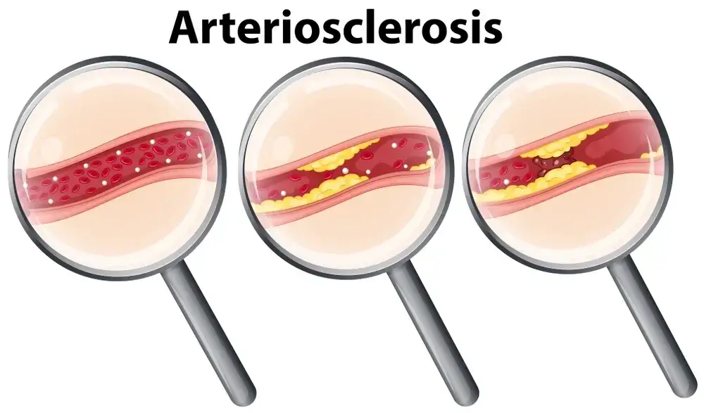 Arteriosclerosis
