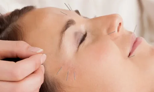 cosmetic-acupuncture-2 (1) cosmetic-acupuncture-2 (1)