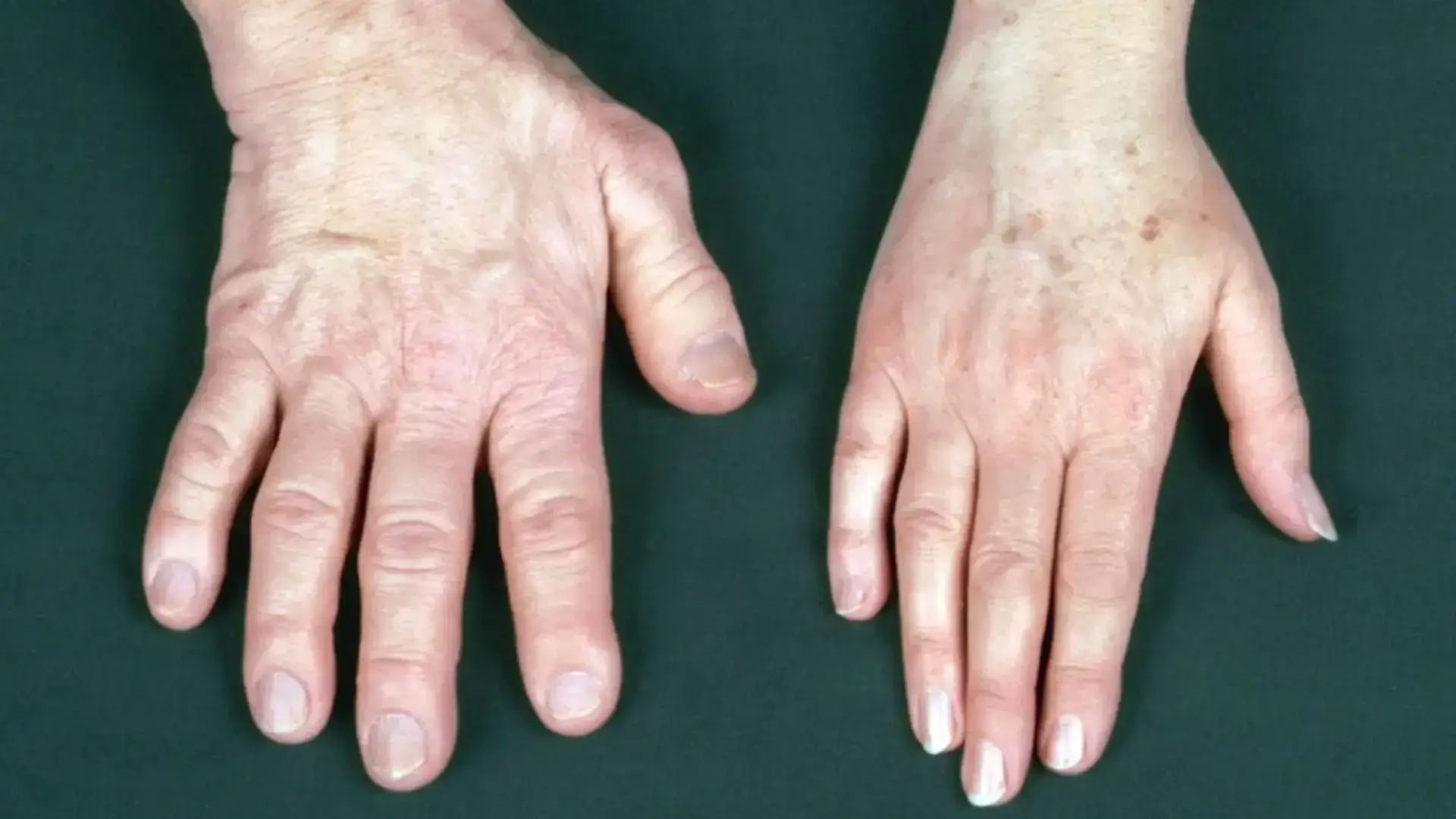Acromegaly Care