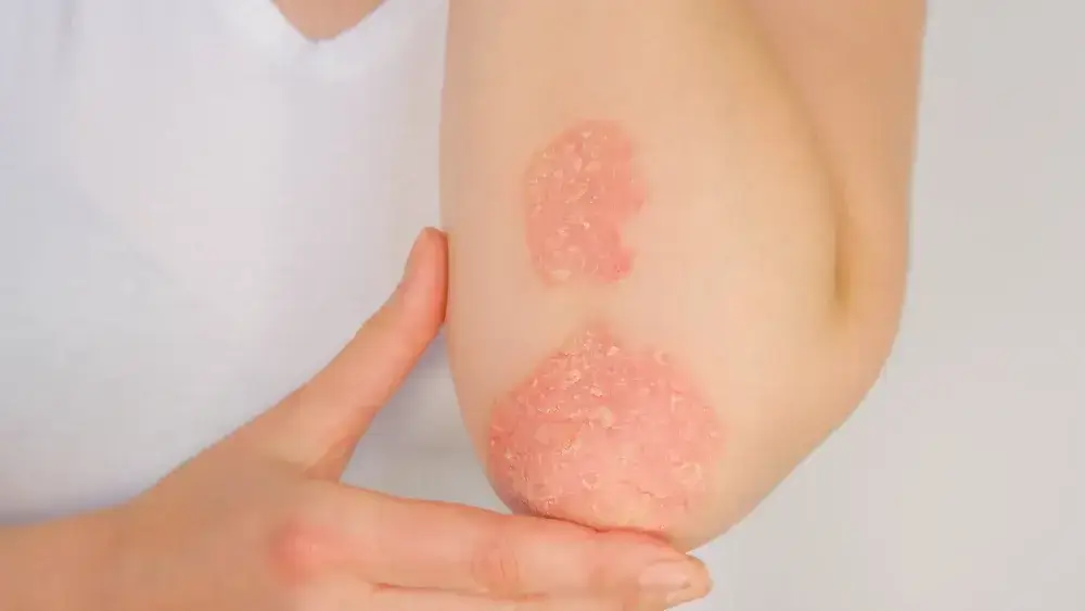 Psoriasis, Skin Disorders