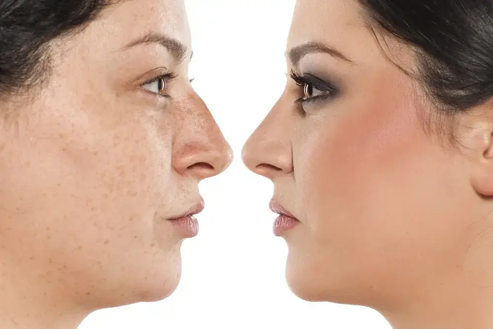 Acne Treatment 1