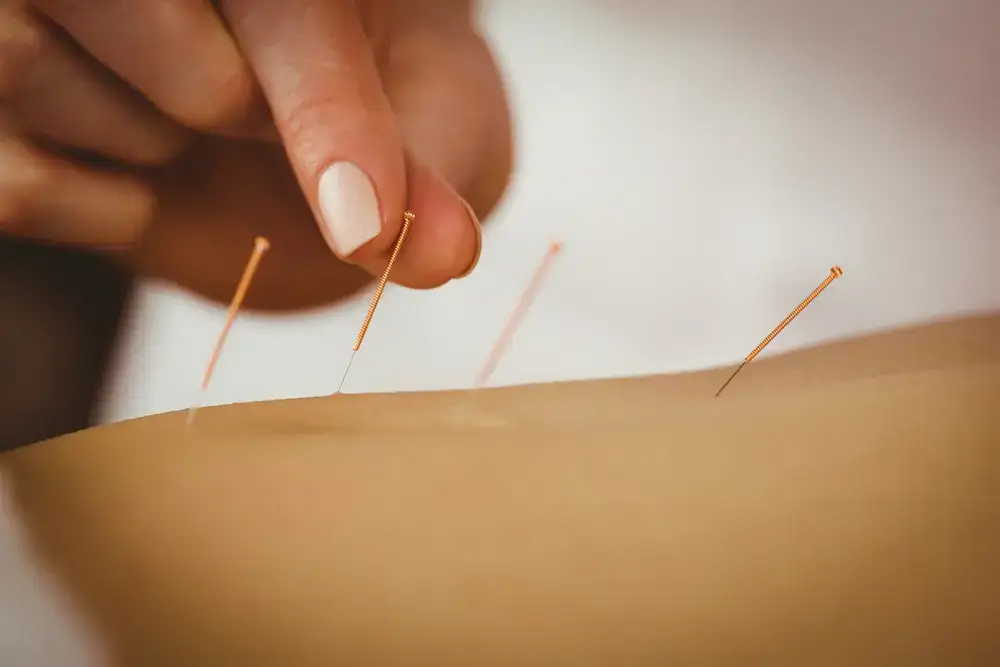 What are Health Benefits of Acupuncture for Digestive Disorders?