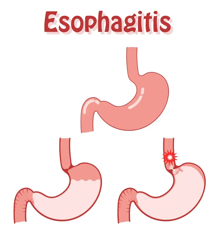 Esophagitis