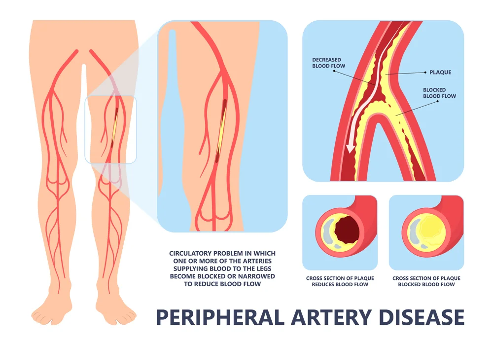 Naturopathic Approaches to Peripheral Vascular Disease