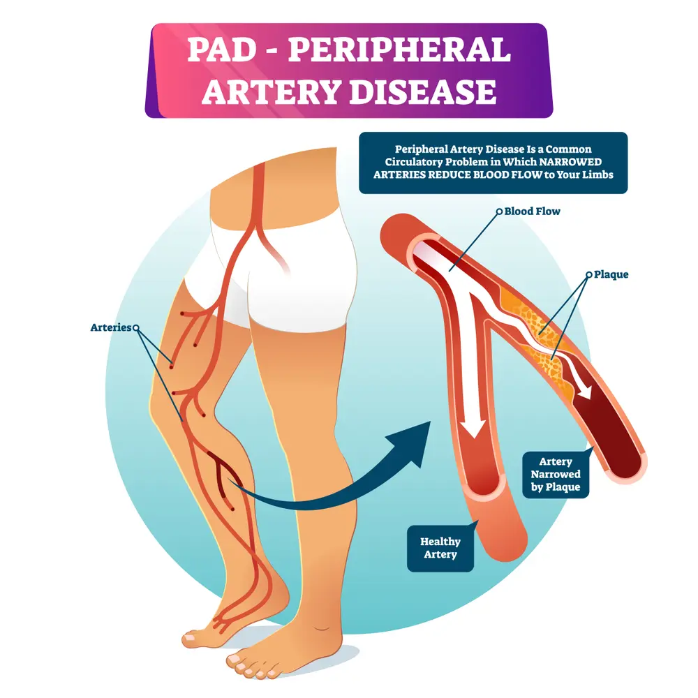 Peripheral Artery Disease (PAD), Poor Blood Circulation