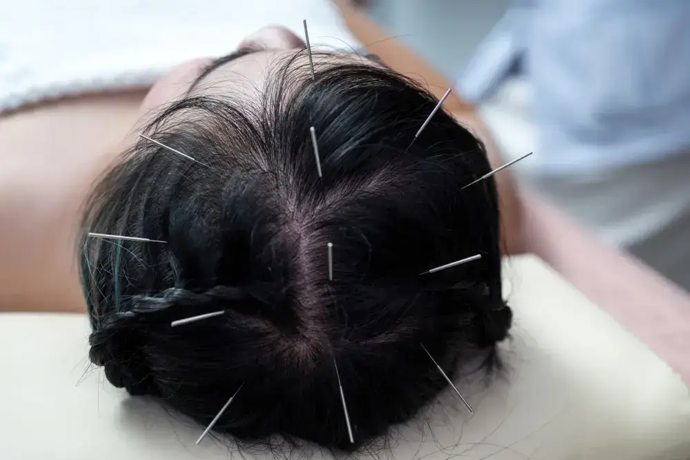 acupuncture benefits neurological symptoms