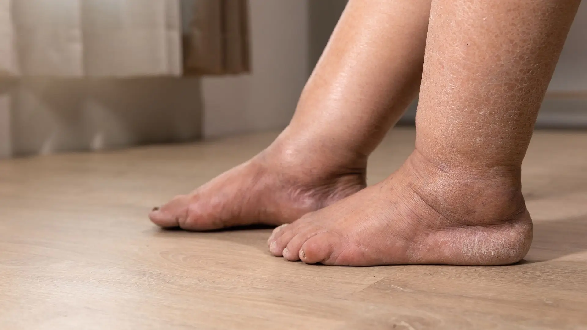 Osteopathic Approaches to Edema and Swelling Relief