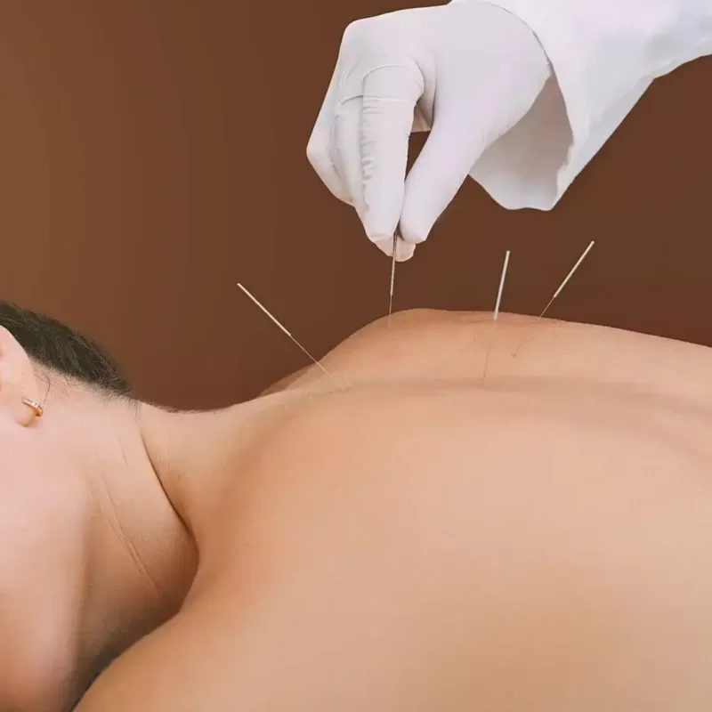 Acupuncture