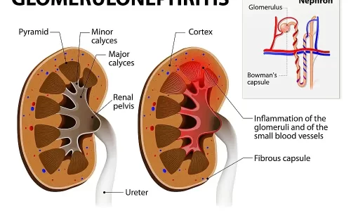 Glomerulonephritis