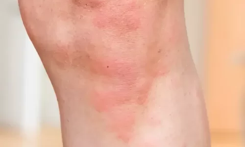 Hives-red-rash