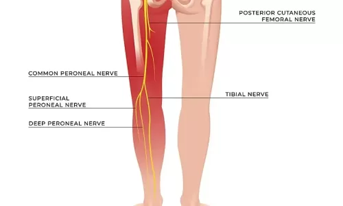 Naturopathic Considerations for Sciatica