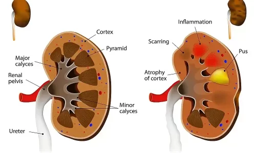 pyelonephritis-symptoms