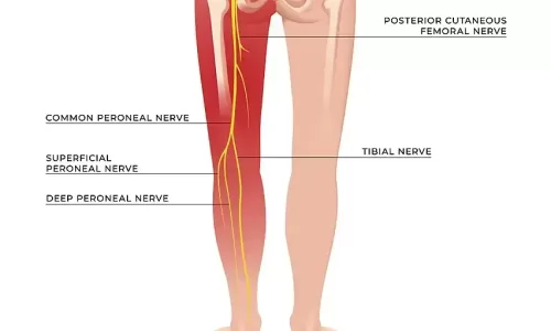 Sciatica Pain Treatment